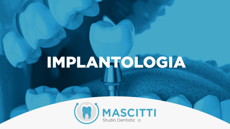 Implantologia: non tutti gli impianti sono uguali. Facciamo chiarezza.